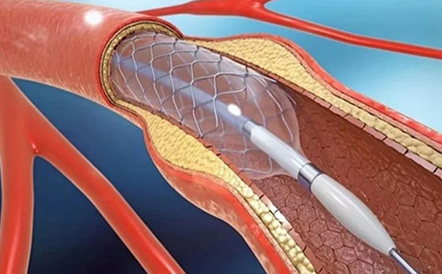 চোরাইপথে আসা হার্টের রিং ব্যবহারে বেড়ে যাচ্ছে রোগীর স্বাস্থ্যঝুঁকি 